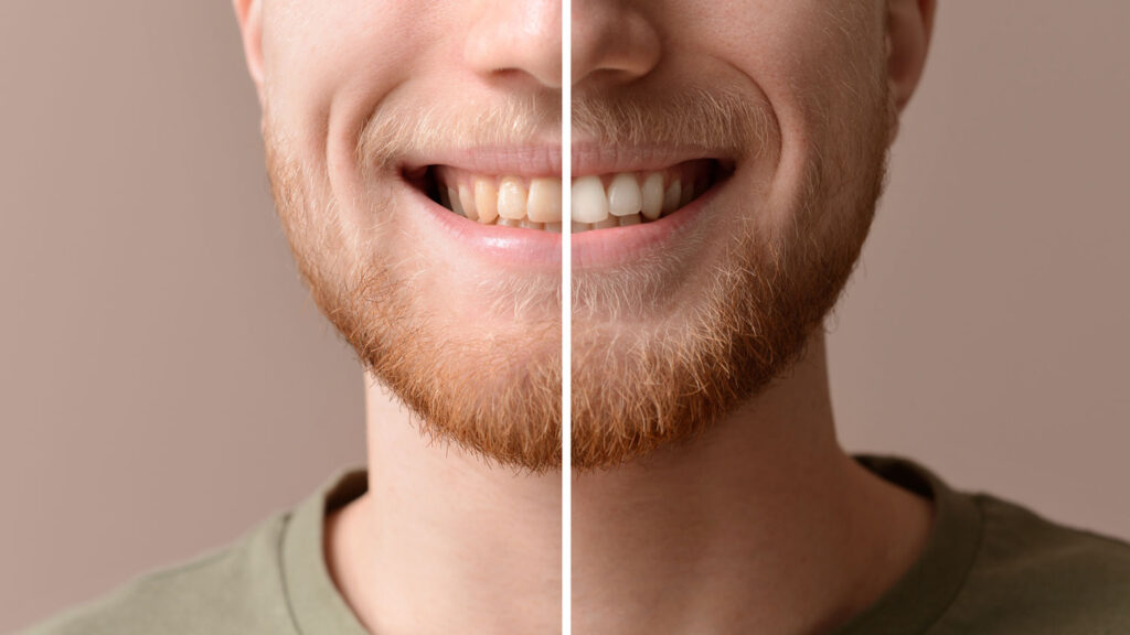 Before and after comparison of teeth whitening treatment results.