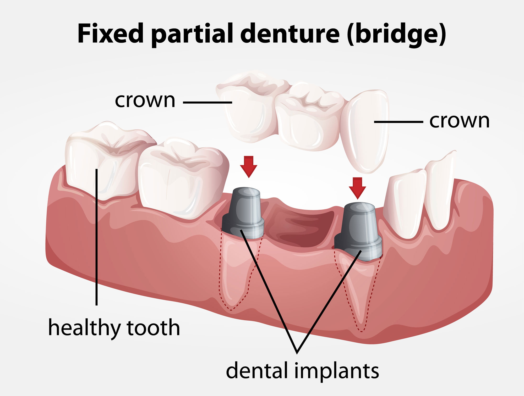 Diagram showing implant-supported bridge with dental implants replacing missing teeth